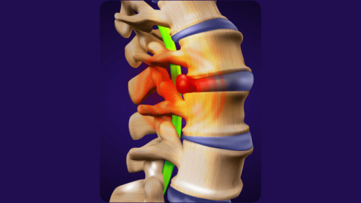 Herniated Disc Treatment: Non-Surgical Solutions for Effective Relief